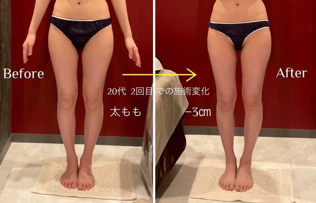 20代 2回目での施術変化 太もも-3cm