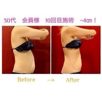 30代 会員様 10回目施術 -4cm
