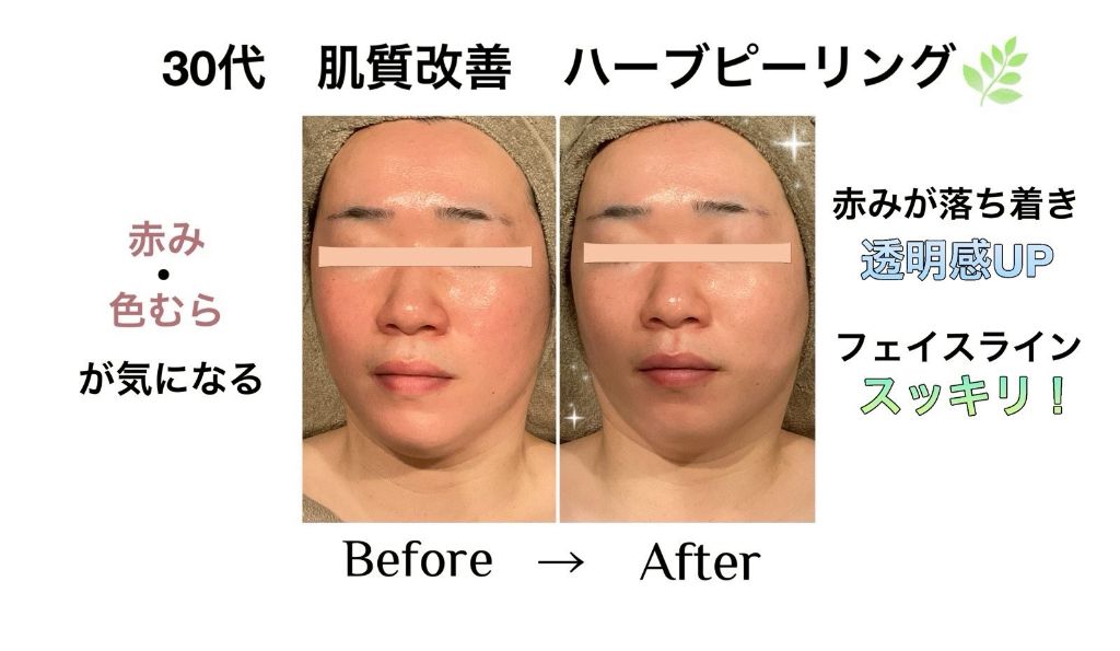 30代 ハーブピーリング 肌質改善 ビフォーアフター