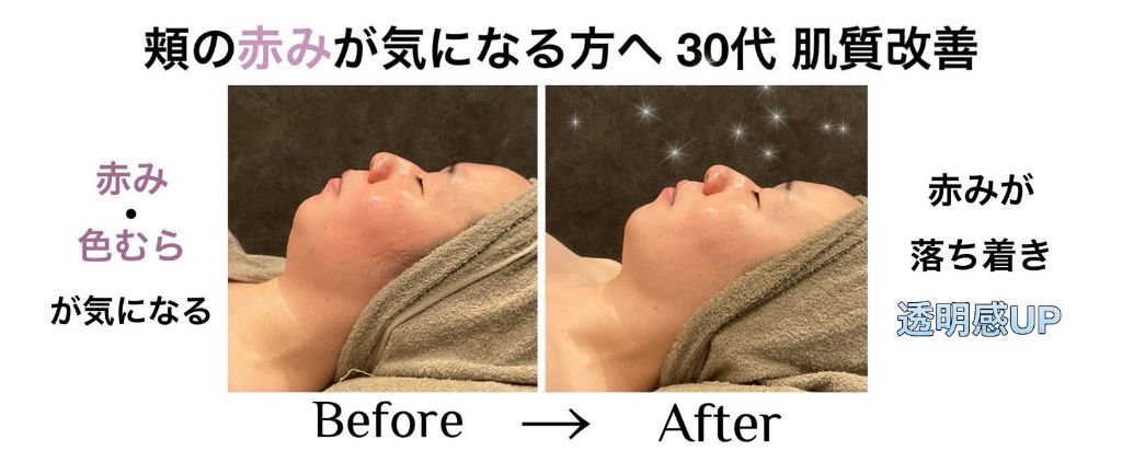 30代 頬の赤みが気になる方へ 肌質改善 ビフォーアフター