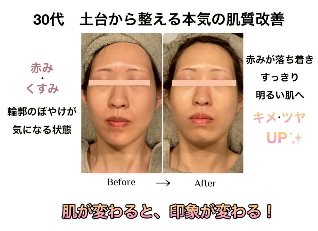 30代 土台から整える本気の肌質改善 ビフォーアフター