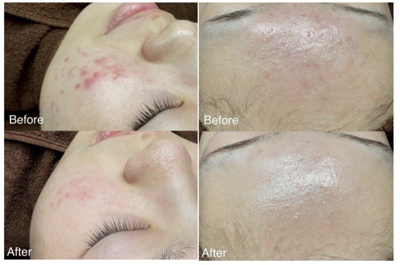 肌質改善 Before/After